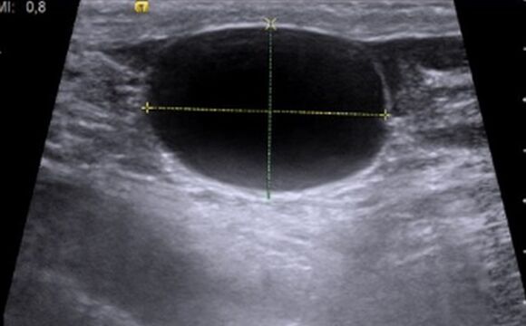 Cystonette helped me cure my chronic cystitis, my bladder is normal