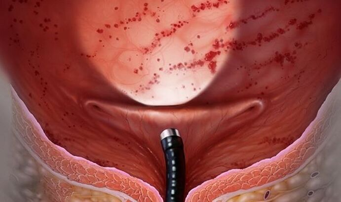 bladder
