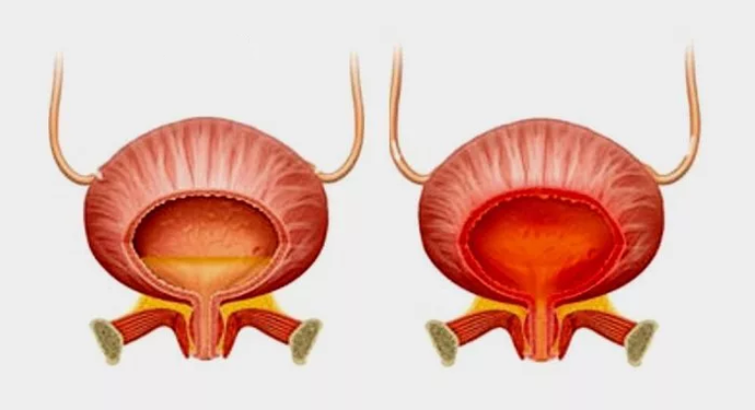 Normal bladder (left) and cystitis with cystitis (right)